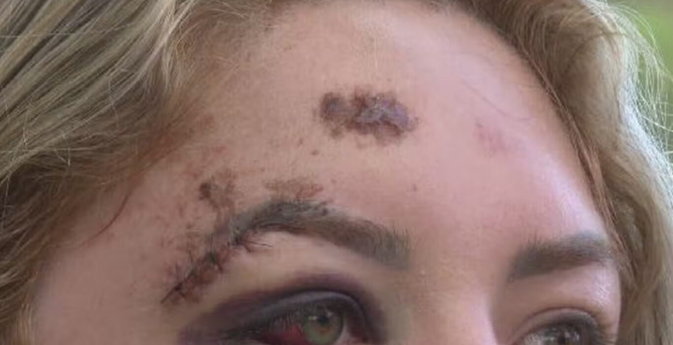 Passageira atropelada por motorista de app em SC sofre paralisia facial e busca justiça