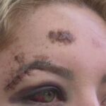 Passageira atropelada por motorista de app em SC sofre paralisia facial e busca justiça