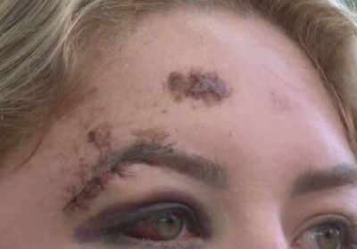 Passageira atropelada por motorista de app em SC sofre paralisia facial e busca justiça